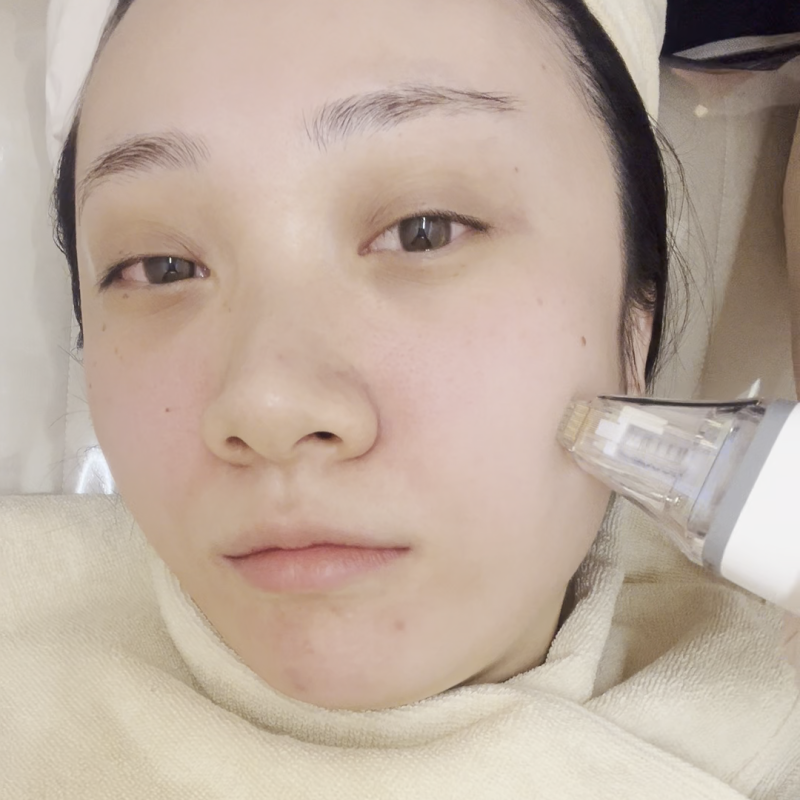 홍대 포텐자 N팁과 펌핑팁, 무엇이 다르고 어떻게 선택할까요? 사진 9