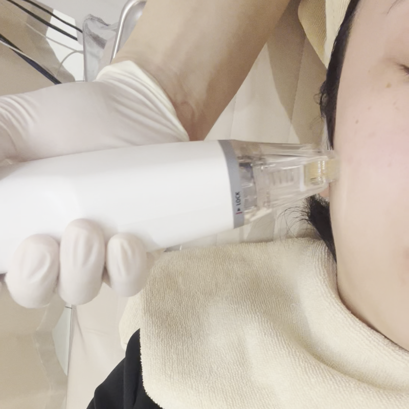 홍대 포텐자 N팁과 펌핑팁, 무엇이 다르고 어떻게 선택할까요? 사진 7
