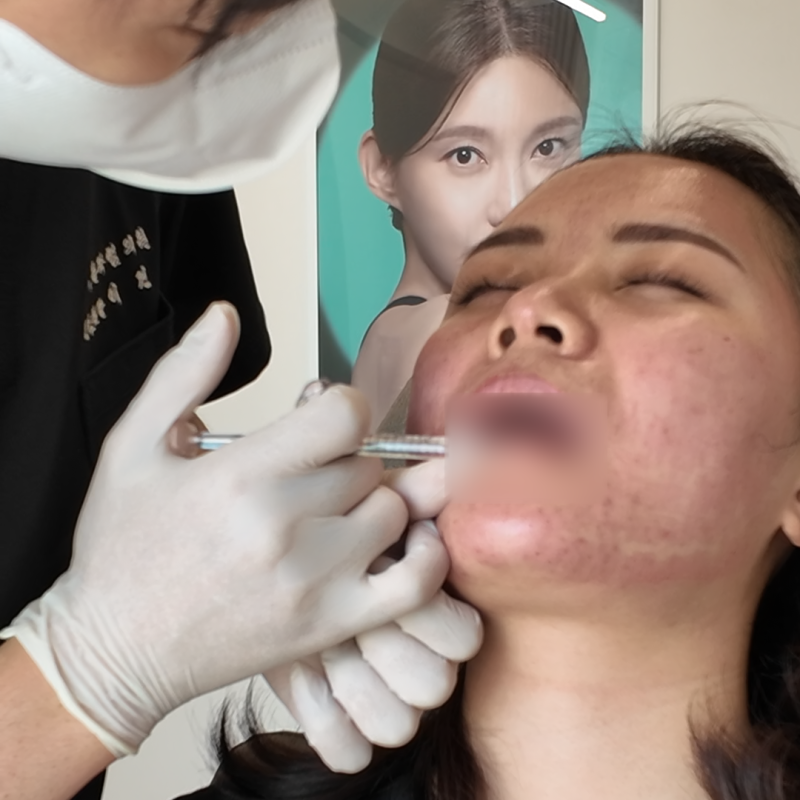 홍대 입술 필러, 처음부터 많이 넣어도 될까요? 사진 8